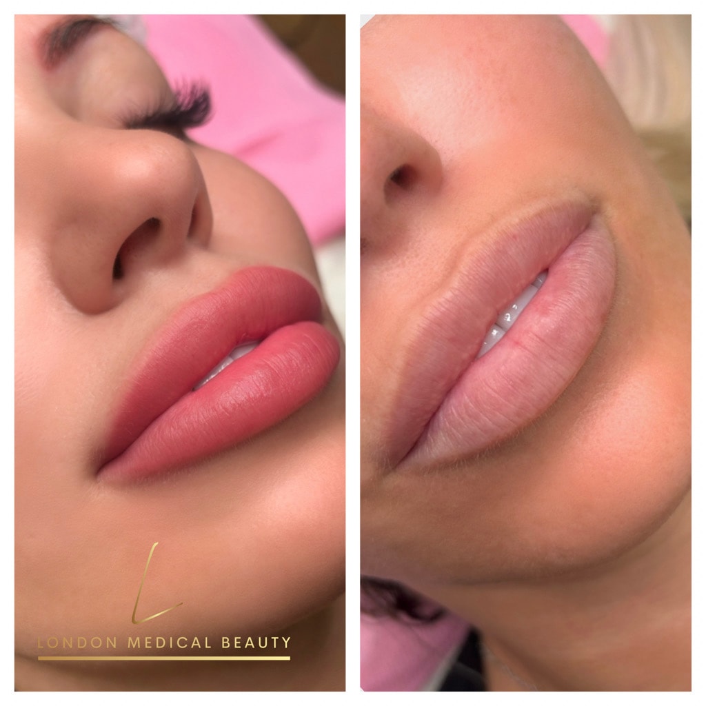 Lip filler before and after
