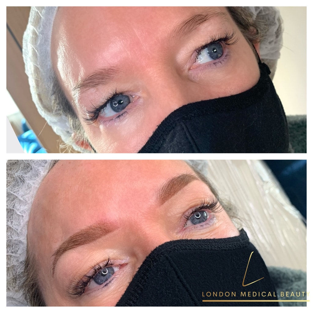 Eyebrow treatment before and after