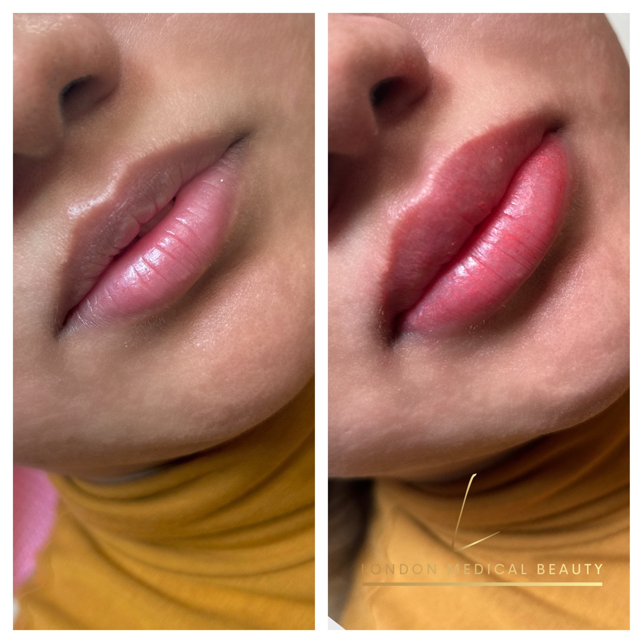 Lip filler before and after