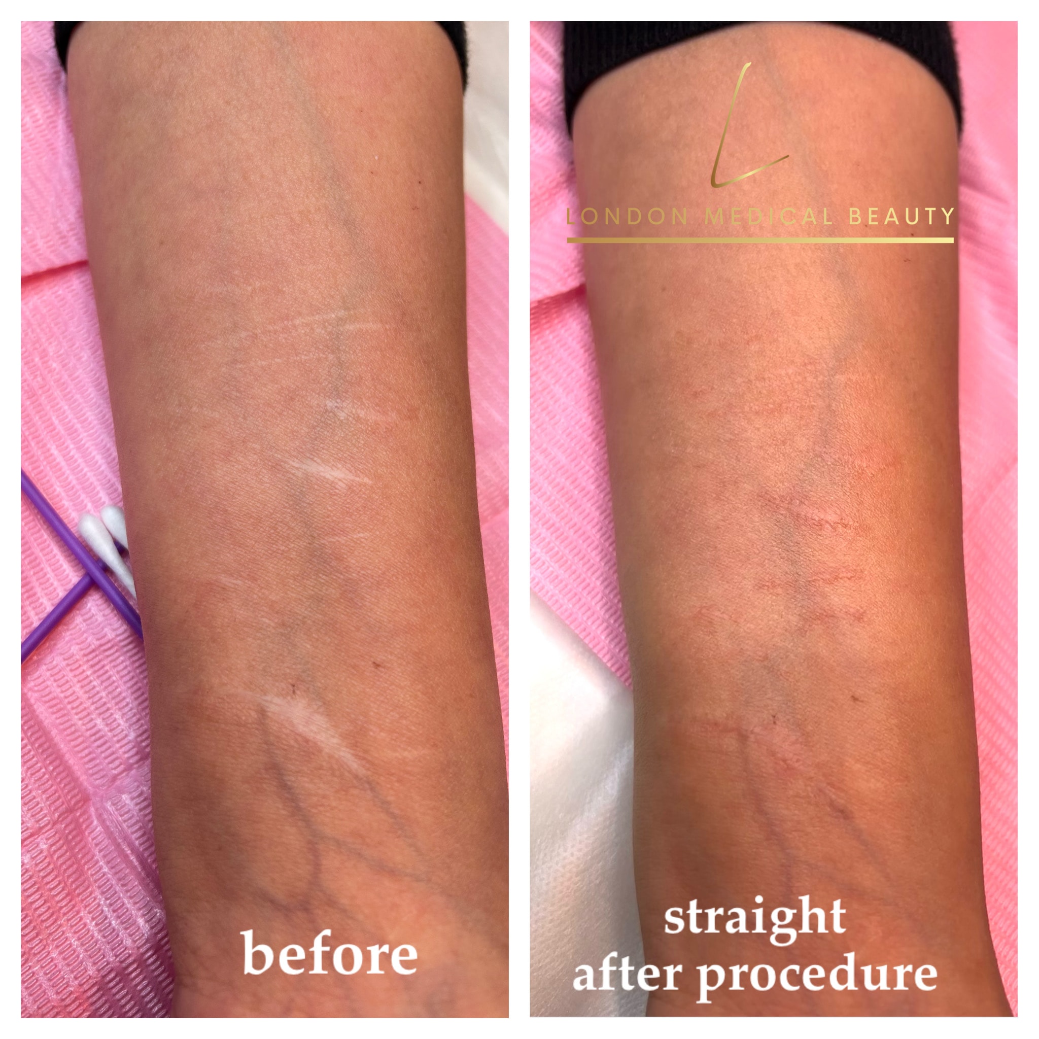 Skin treatment before and after