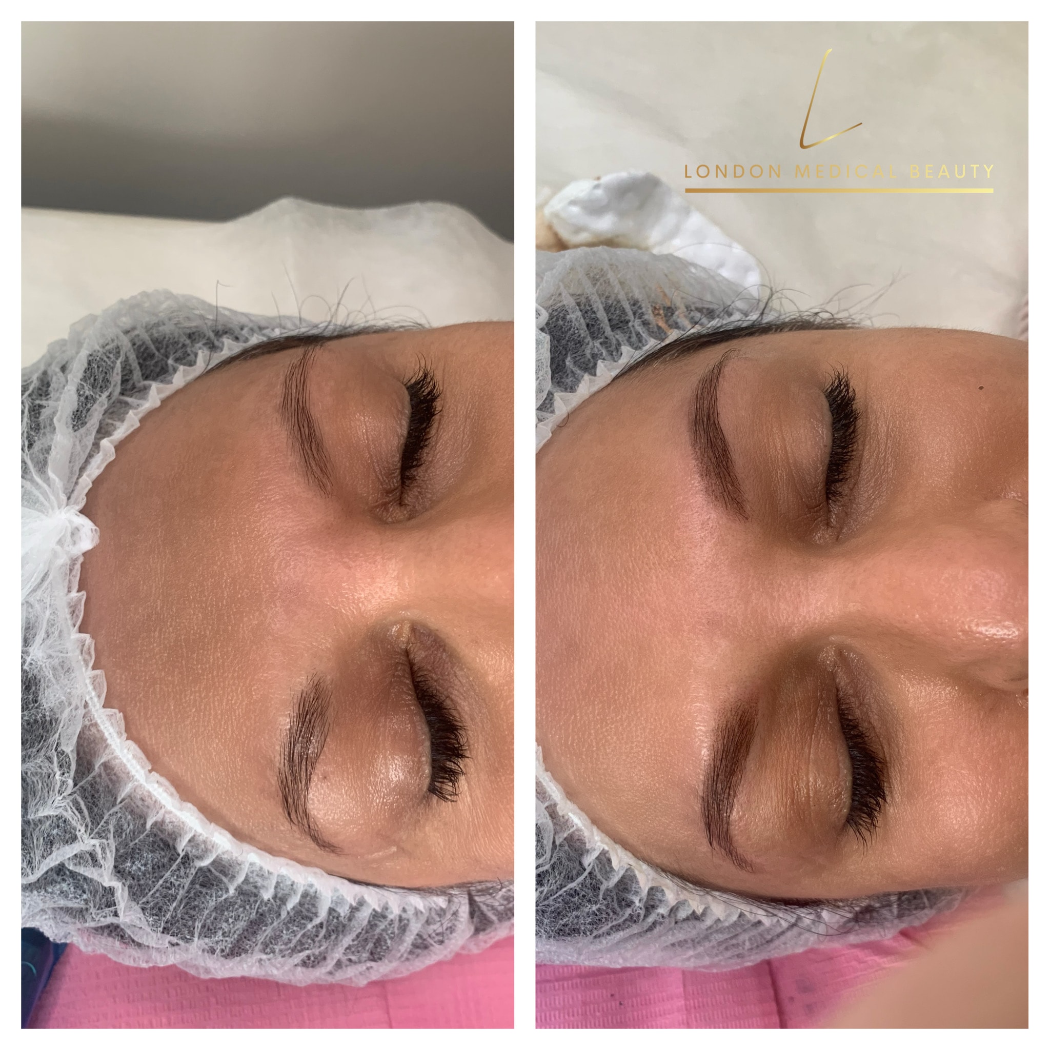 Eyelash treatment before and after