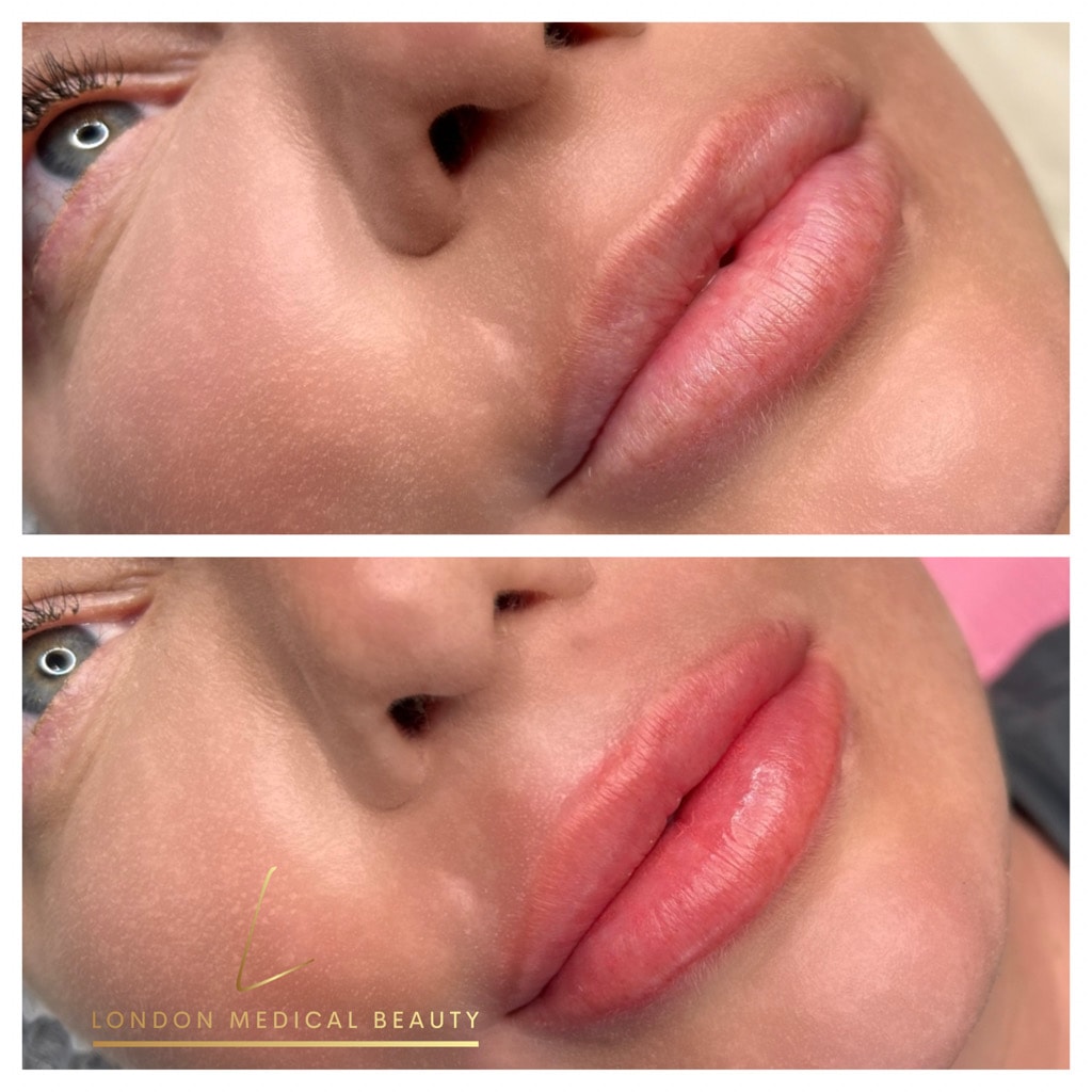 Lip filler before and after