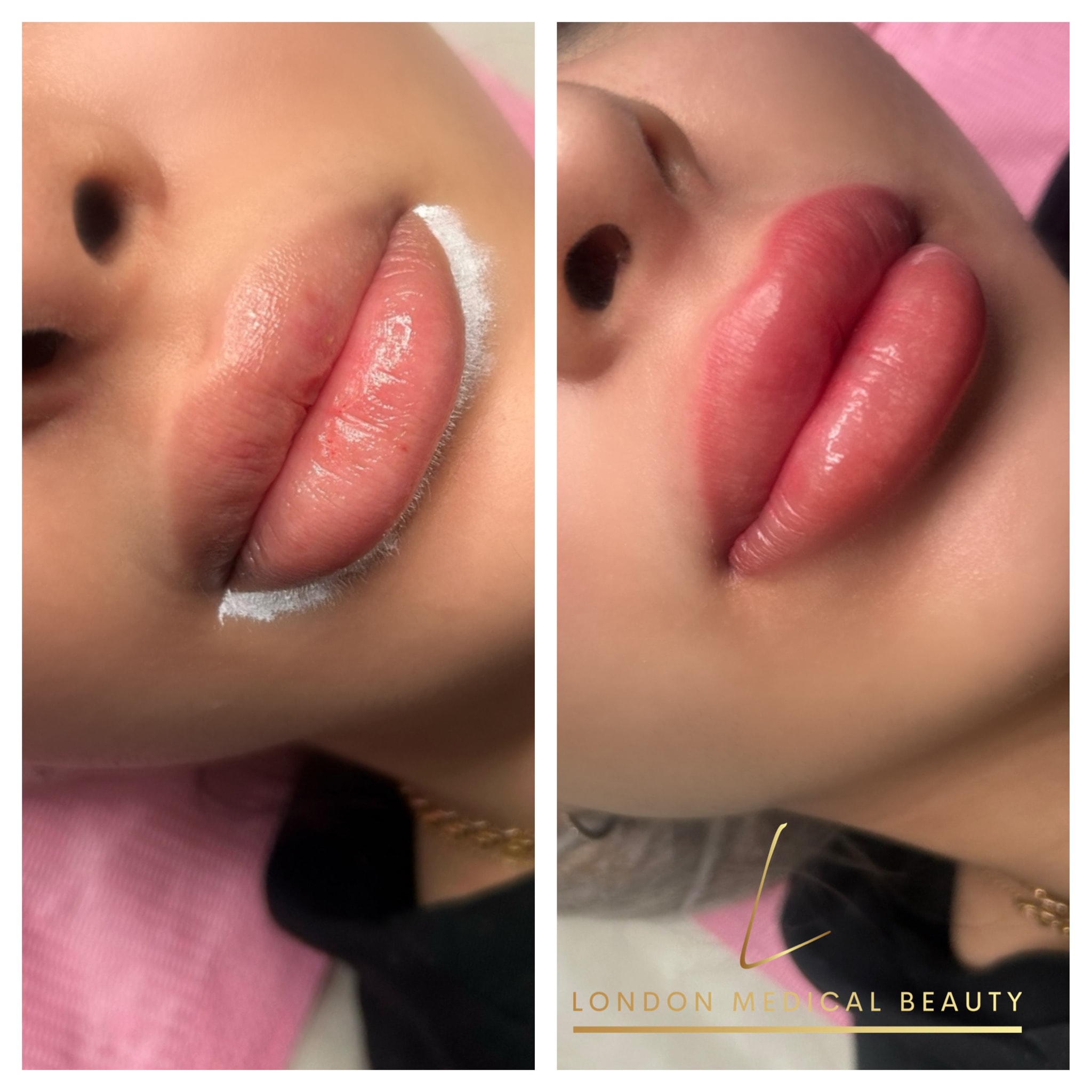 Lip treatment before and after